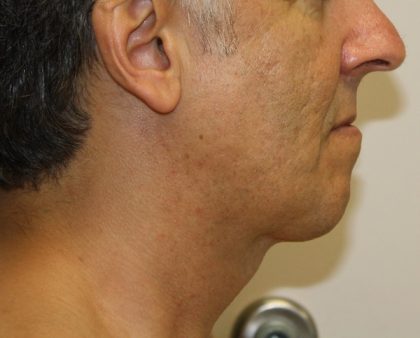 Neck Liposuction Before & After Patient #1213