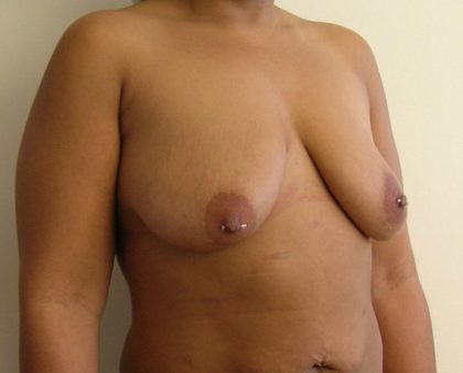 Breast Lift Before & After Patient #802