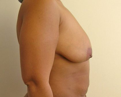 Breast Augmentation Before & After Patient #1477