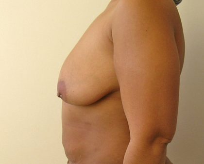 Breast Augmentation Before & After Patient #1477