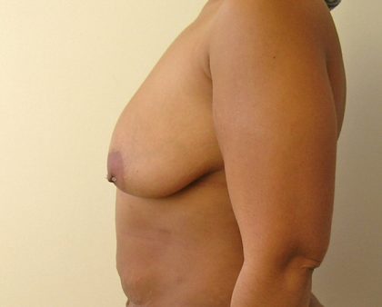 Breast Lift Before & After Patient #802