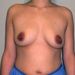 Breast Augmentation Before & After Patient #1488