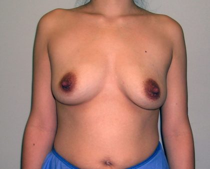 Breast Augmentation Before & After Patient #1488
