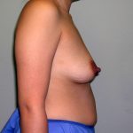 Breast Augmentation Before & After Patient #1488