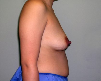 Breast Augmentation Before & After Patient #1488