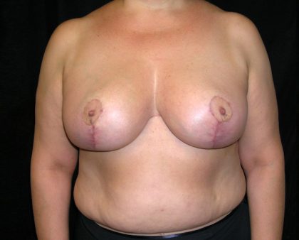 Breast Reduction Before & After Patient #989