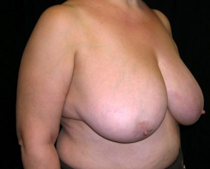 Breast Reduction Before & After Patient #989