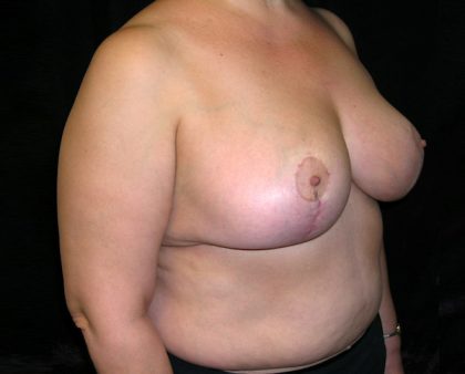 Breast Reduction Before & After Patient #989