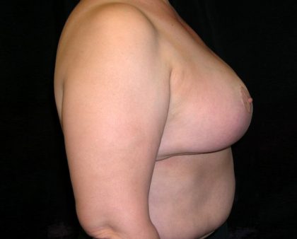 Breast Reduction Before & After Patient #989