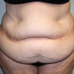 Tummy Tuck Before & After Patient #628