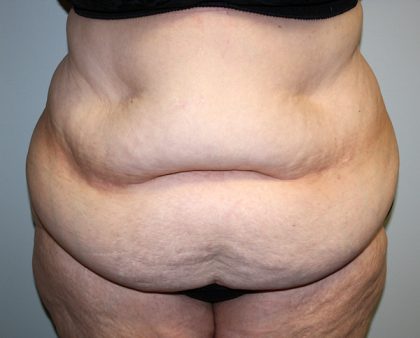 Tummy Tuck Before & After Patient #628