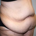 Tummy Tuck Before & After Patient #628