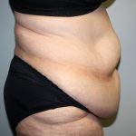 Tummy Tuck Before & After Patient #628