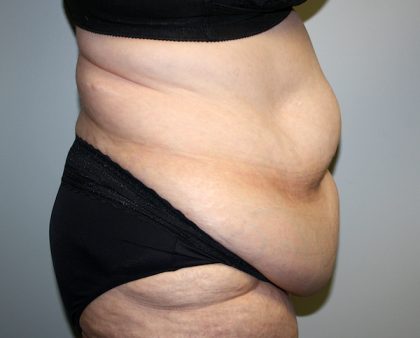 Tummy Tuck Before & After Patient #628