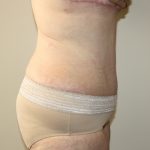 Tummy Tuck Before & After Patient #628