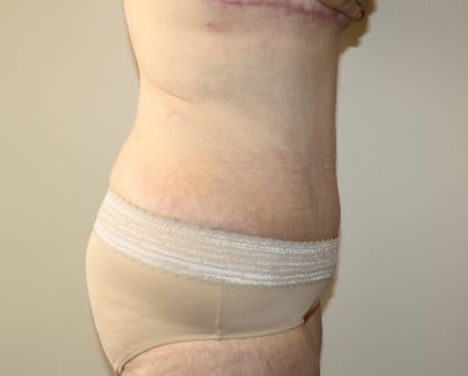 Tummy Tuck Before & After Patient #628