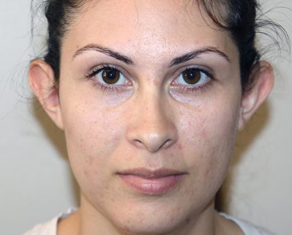 Otoplasty Before & After Patient #1329