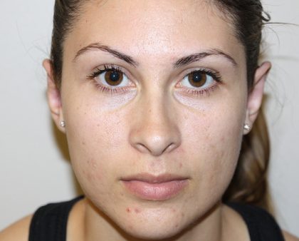 Otoplasty Before & After Patient #1329