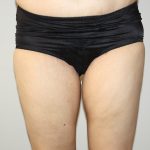 Thigh Lift Before & After Patient #1385