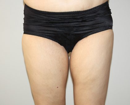 Thigh Lift Before & After Patient #1385