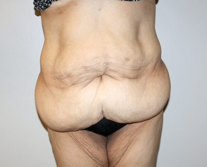 Tummy Tuck Before & After Patient #521