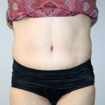 Tummy Tuck Before & After Patient #521