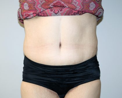 Tummy Tuck Before & After Patient #521