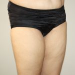 Thigh Lift Before & After Patient #1385