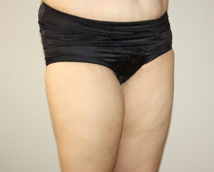 Thigh Lift Before & After Patient #1385