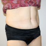 Tummy Tuck Before & After Patient #521