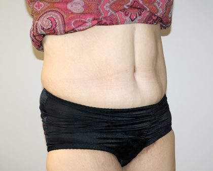 Tummy Tuck Before & After Patient #521