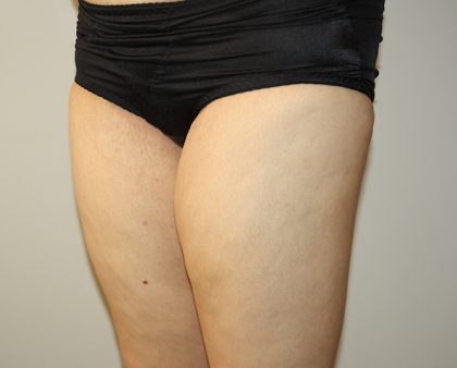 Thigh Lift Before & After Patient #1385