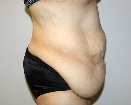 Tummy Tuck Before & After Patient #521