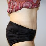 Tummy Tuck Before & After Patient #521