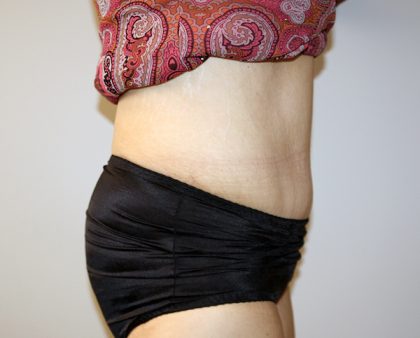 Tummy Tuck Before & After Patient #521