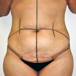 Tummy Tuck Before & After Patient #635