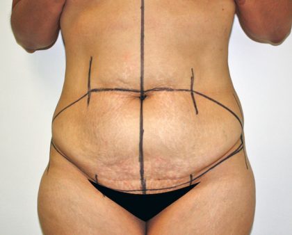 Tummy Tuck Before & After Patient #635
