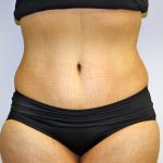 Tummy Tuck Before & After Patient #635