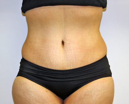 Tummy Tuck Before & After Patient #635