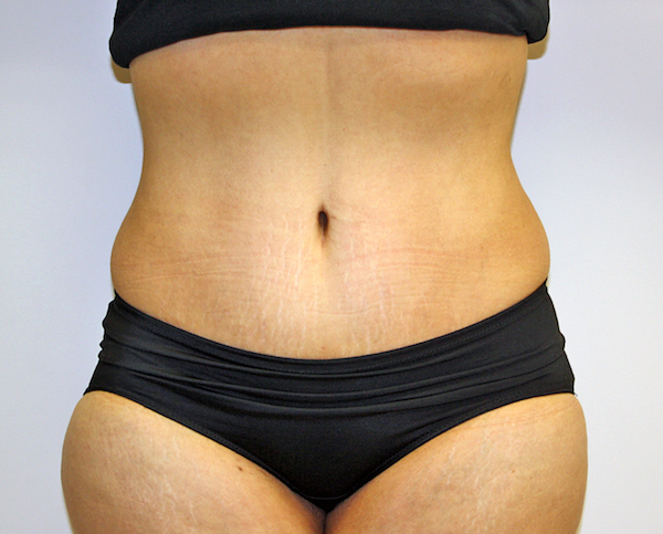 Tummy Tuck Before & After Patient #635