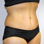 Tummy Tuck Before & After Patient #635