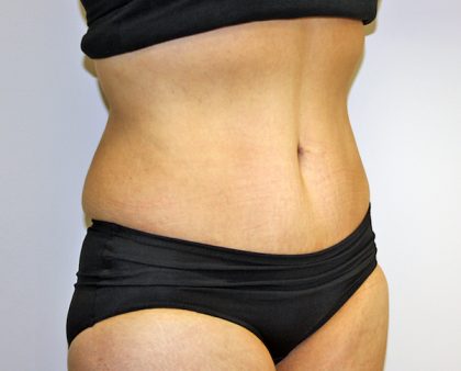 Tummy Tuck Before & After Patient #635