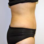 Tummy Tuck Before & After Patient #635