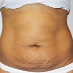 Tummy Tuck Before & After Patient #496