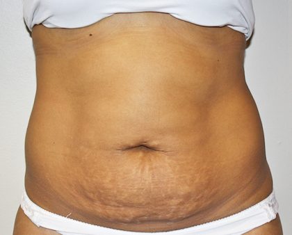 Tummy Tuck Before & After Patient #496