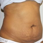 Tummy Tuck Before & After Patient #496