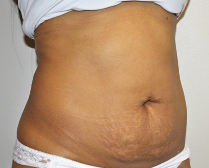 Tummy Tuck Before & After Patient #496