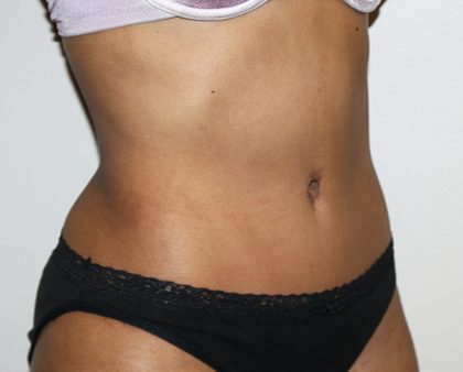 Tummy Tuck Before & After Patient #496