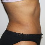 Tummy Tuck Before & After Patient #496