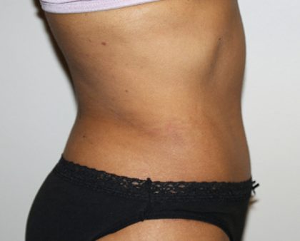 Tummy Tuck Before & After Patient #496